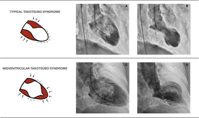Comparative electrocardiographic analysis of midventricular and typical takotsubo syndrome