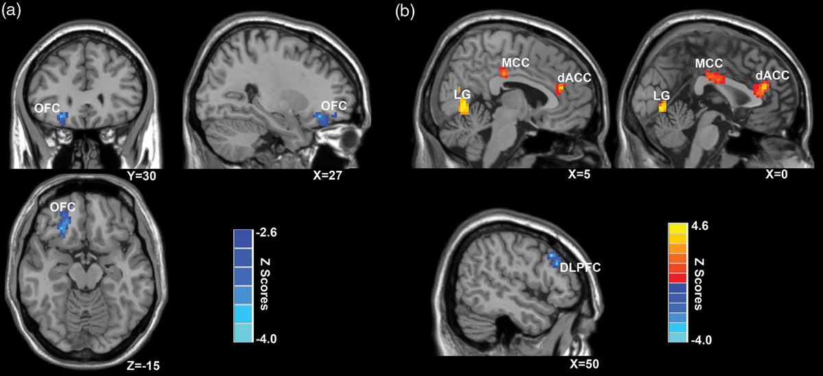Altered cognitive control network mediates the association between long-term pain and anxiety symptoms in primary dysmenorrhea