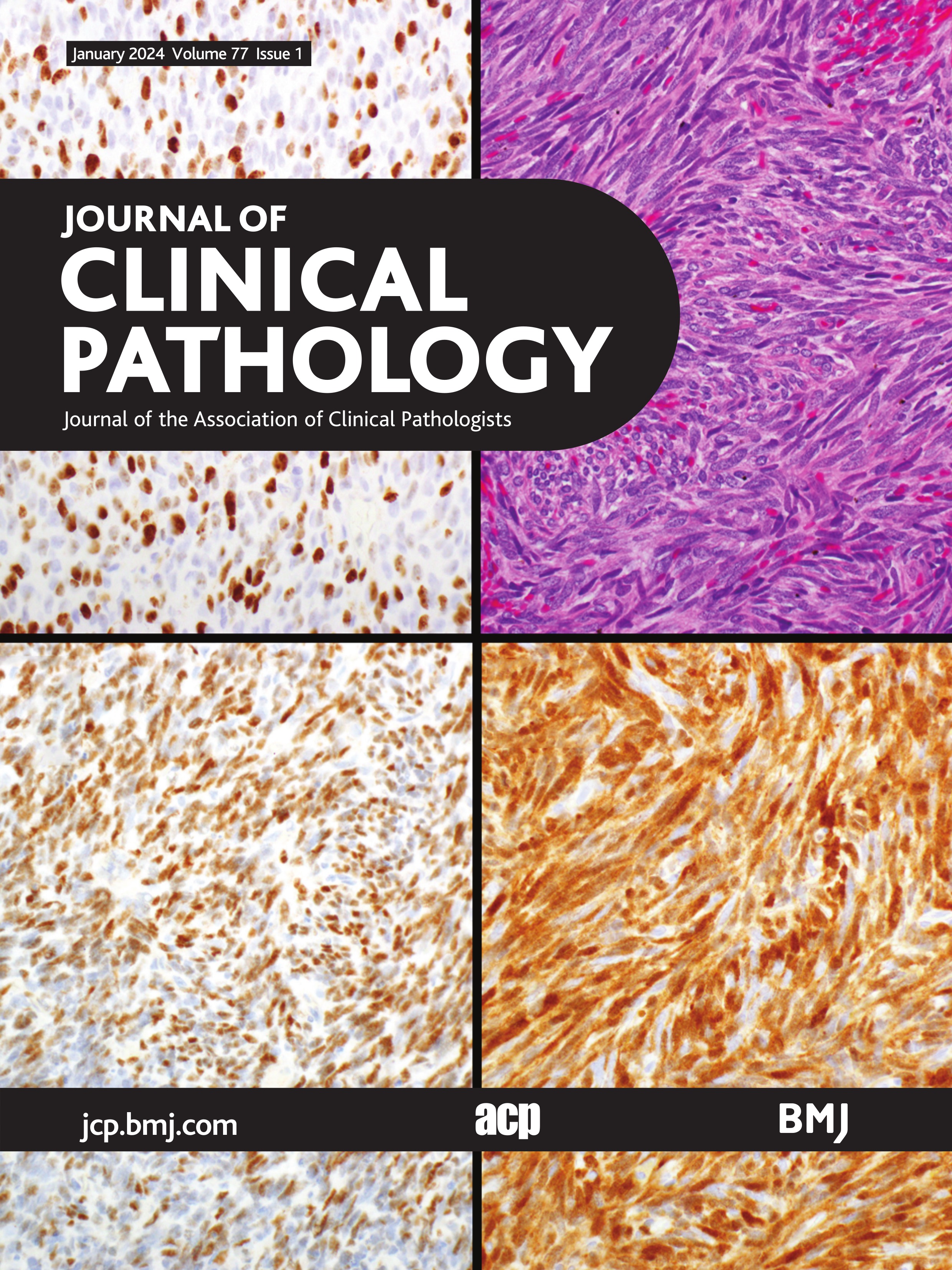 Granulomas in bone marrow biopsies: clinicopathological significance and new perspectives