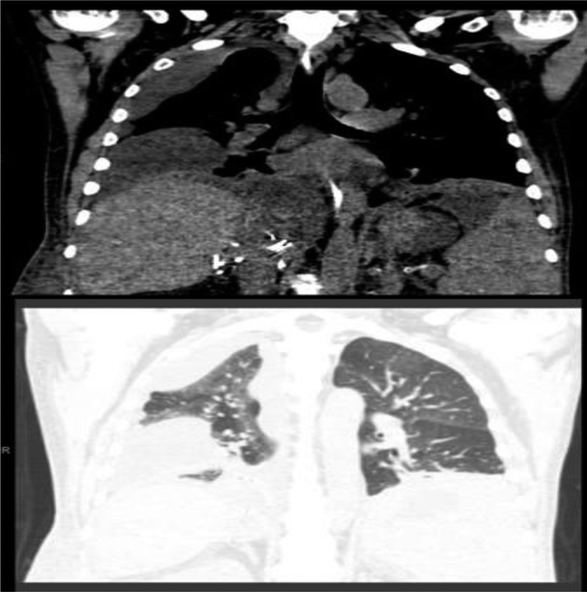 Cryptococcal Infection Presenting as a Pleural Effusion in a Liver Transplant Recipient