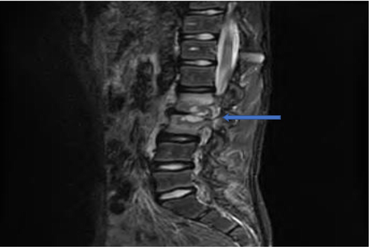Lumbar Osteomyelitis and Epidural Abscess Caused by Cardiobacterium hominis—First Reported Case in the Pediatric Population: The Role of Universal 16S rRNA Gene PCR and Sequencing