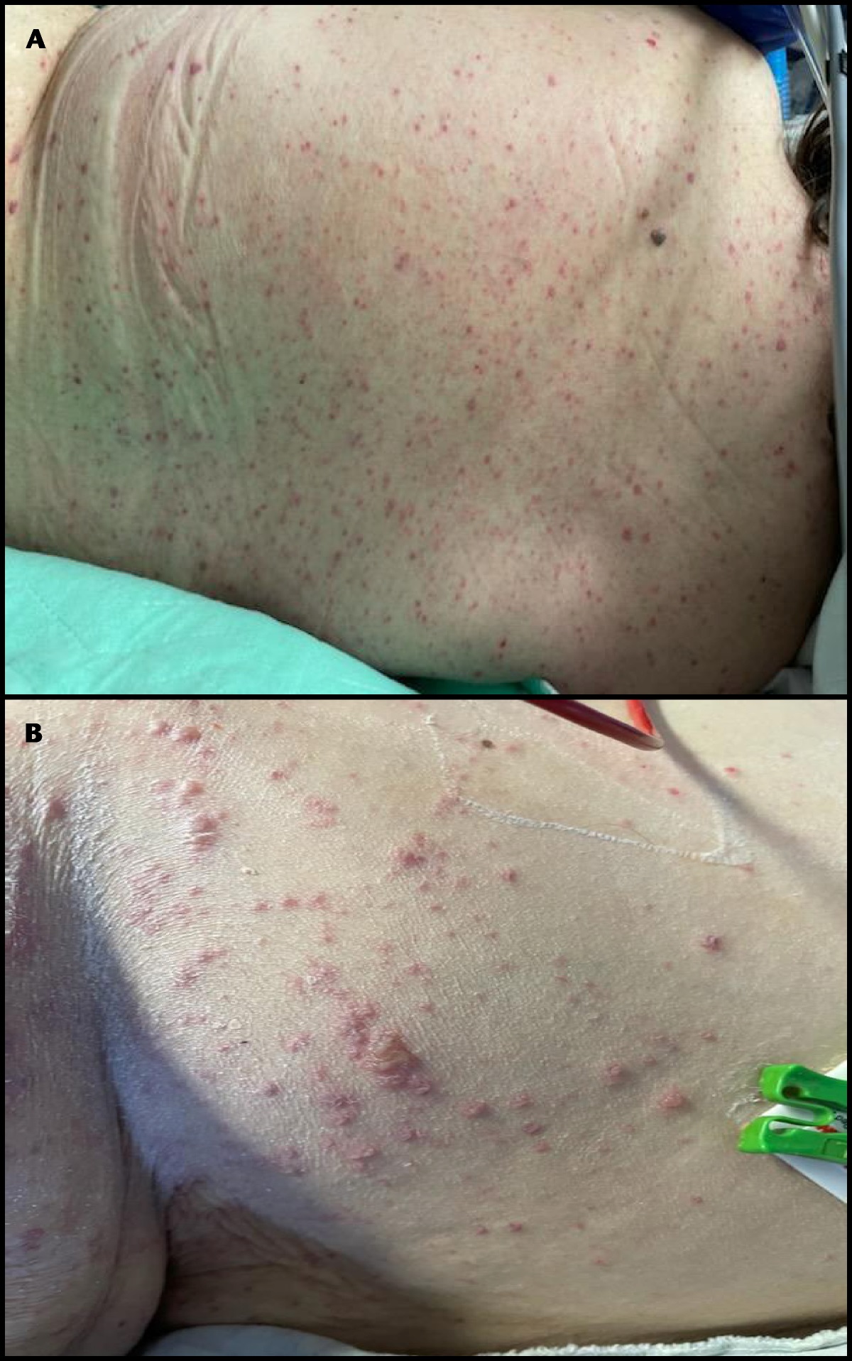 An Atypical Presentation of Disseminated Varicella Infection
