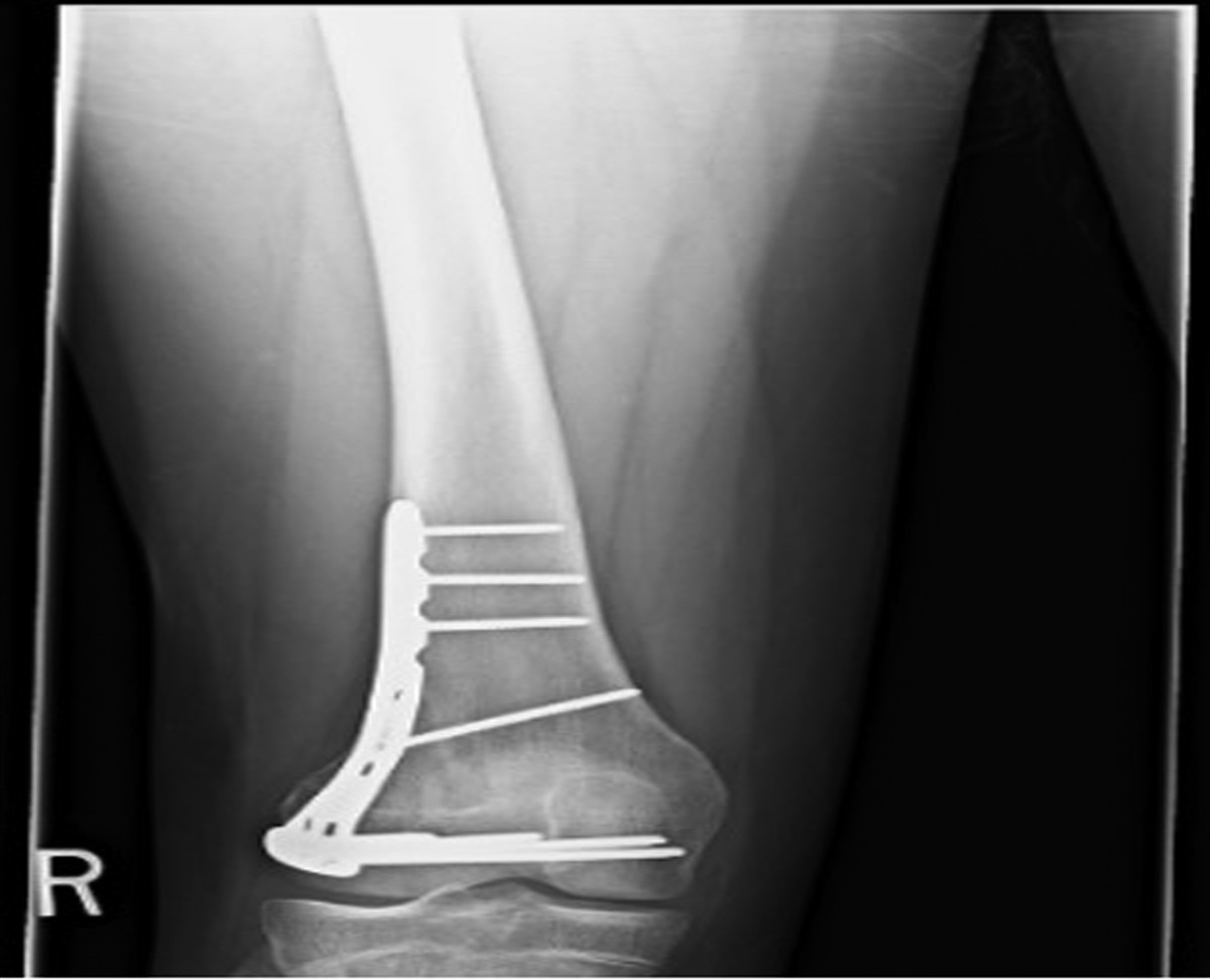 Fixation of Distal Femur Fractures With the Use of Periarticular Tibial Locking Plates