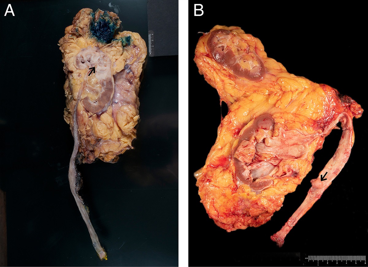 Contemporary Issues in Urothelial Carcinoma of Upper Urinary Tract