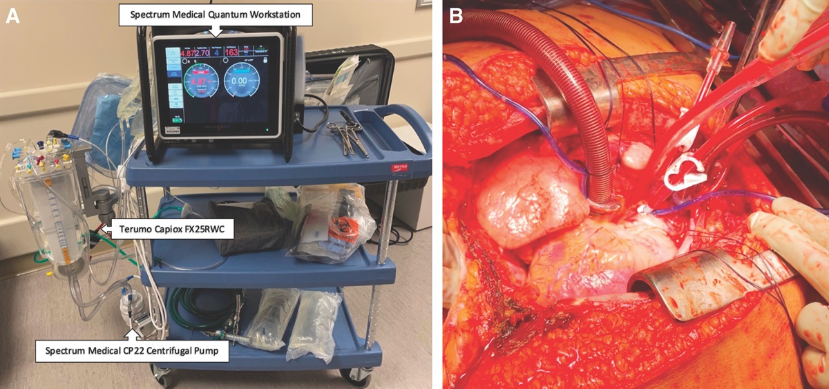 Heart–Lung Transplantation From Donation After Circulatory Death Using Mobile Normothermic Regional Perfusion