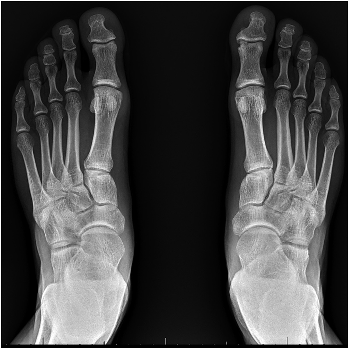 Traumatic rupture of the flexor hallucis brevis tendon. Case report and review of the literature