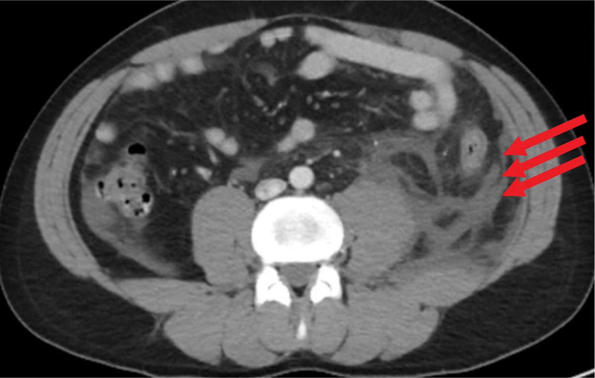 A Case Report of Tension Hydrothorax Incited by Bowel Perforation