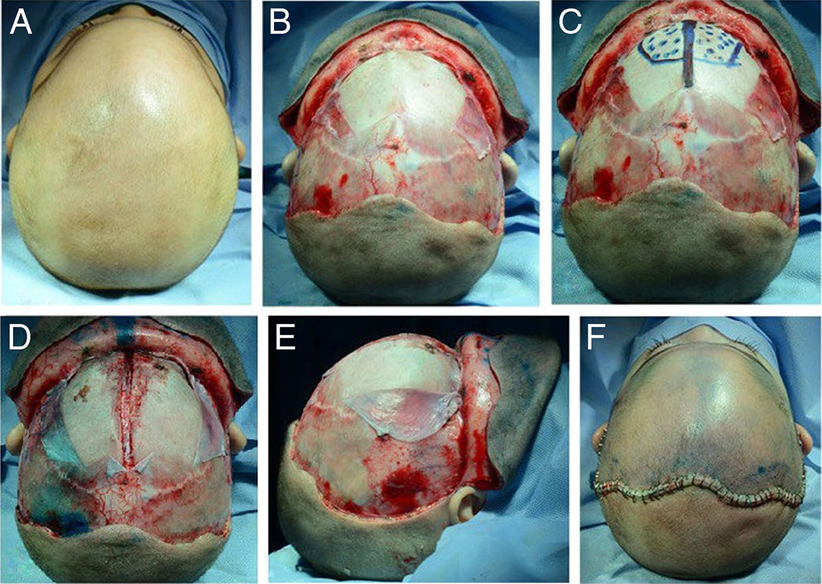 Surgical Treatment of Trigonocephaly, Simplified Technique for Moderate Cases