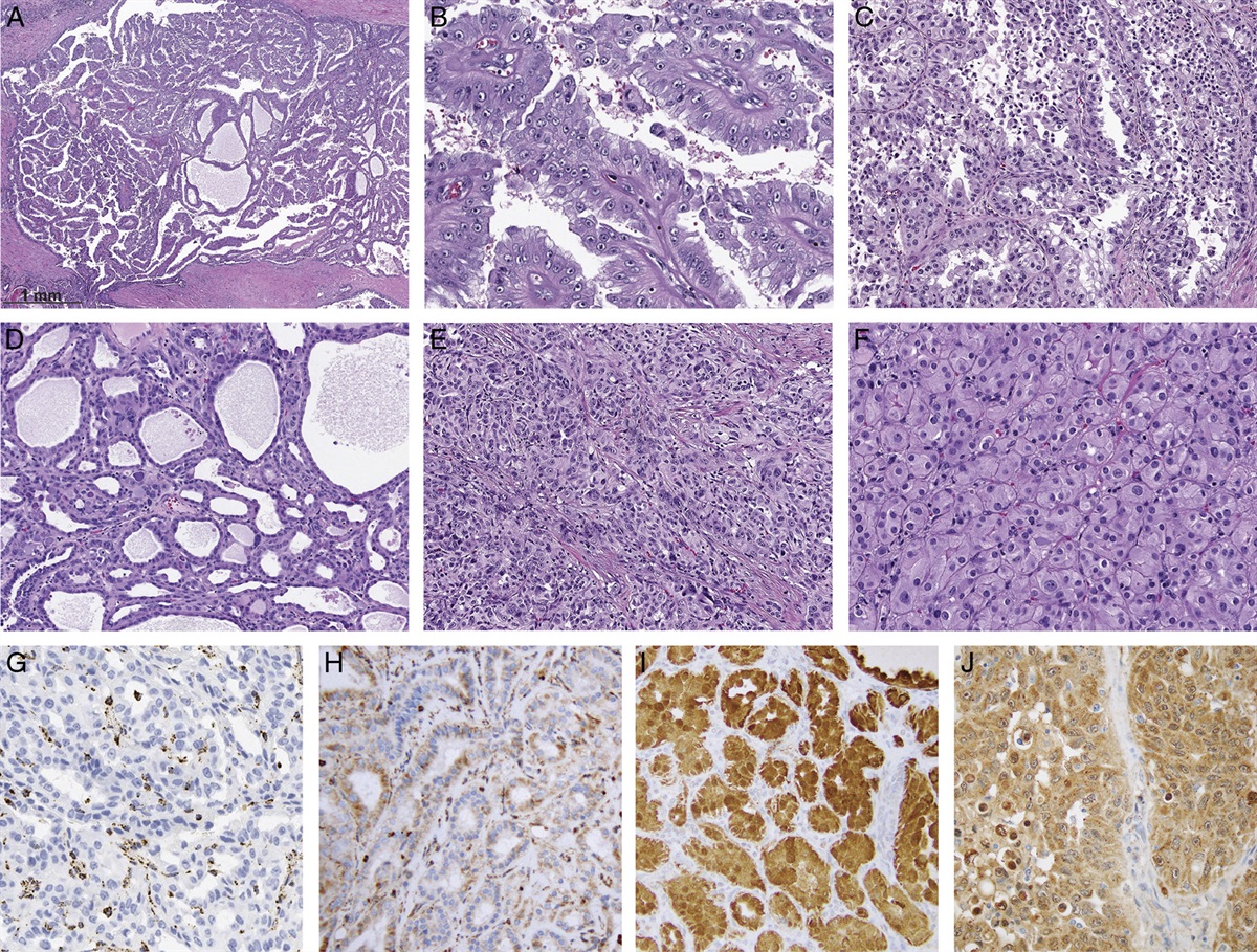 Update on Selected High-grade Renal Cell Carcinomas of the Kidney: FH-deficient, ALK-rearranged, and Medullary Carcinomas