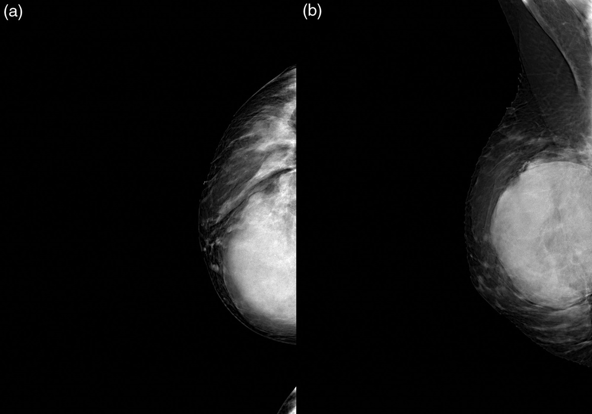 Clinical and radiological evaluation of a phyllodes tumor of the breast: a case report