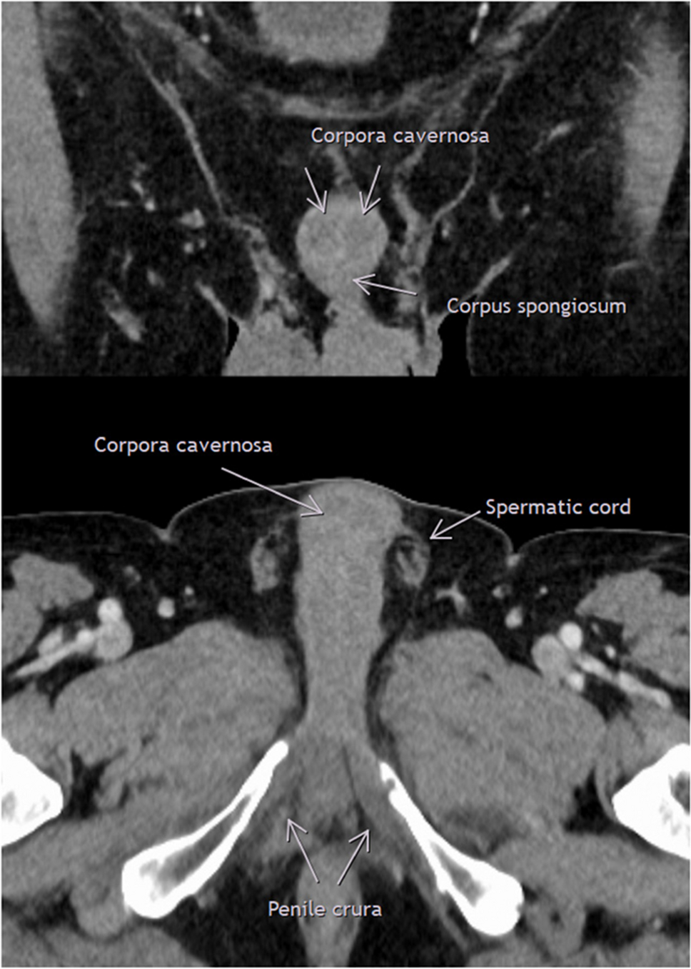 A pictorial review of scrotal and penile pathology on computed tomography