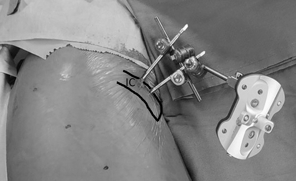 Rigid fixation of pelvic tracker essential for accurate cup placement in CT-based navigation total hip arthroplasty