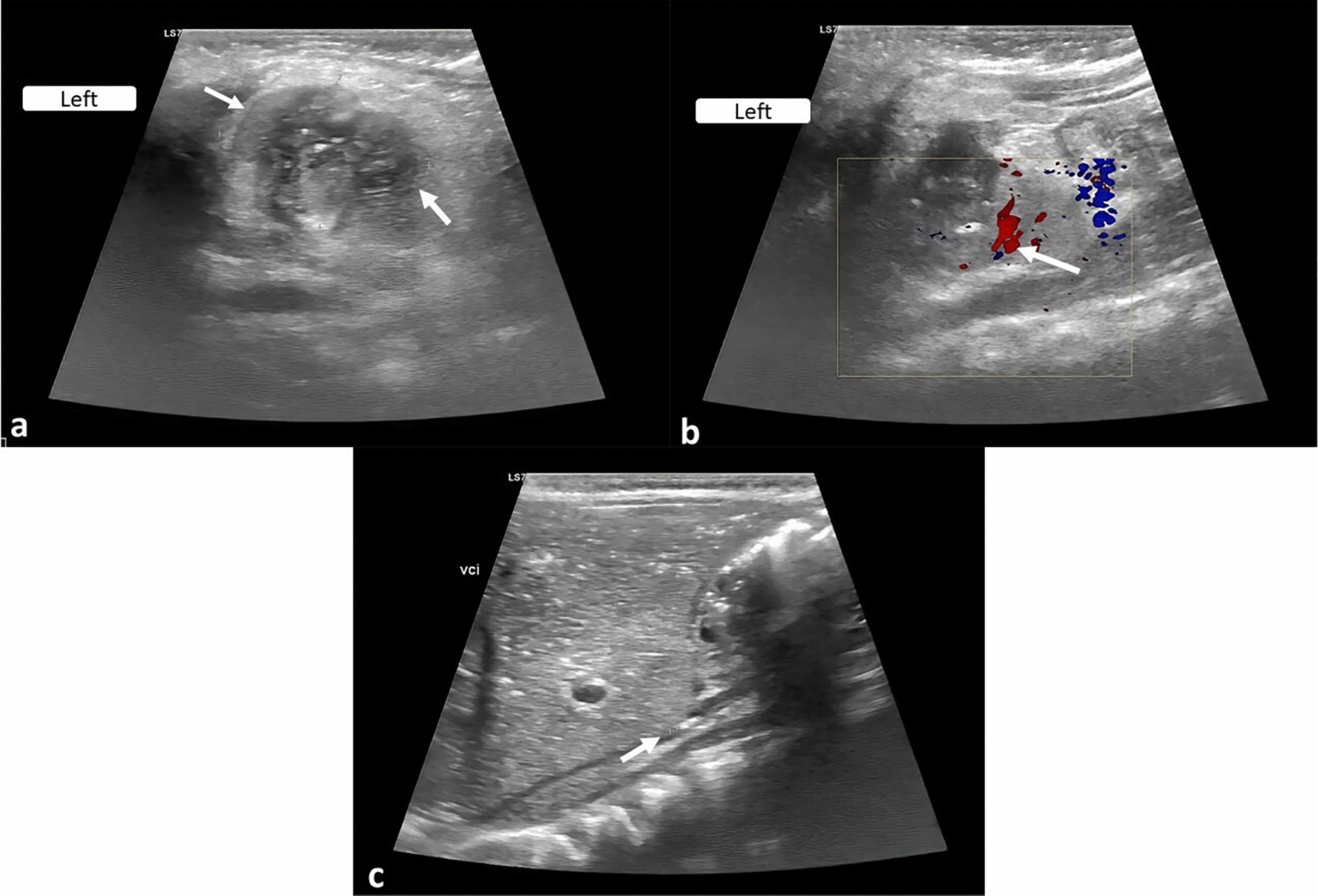 An unusual cause of renal vein thrombosis in a newborn: COVID-19