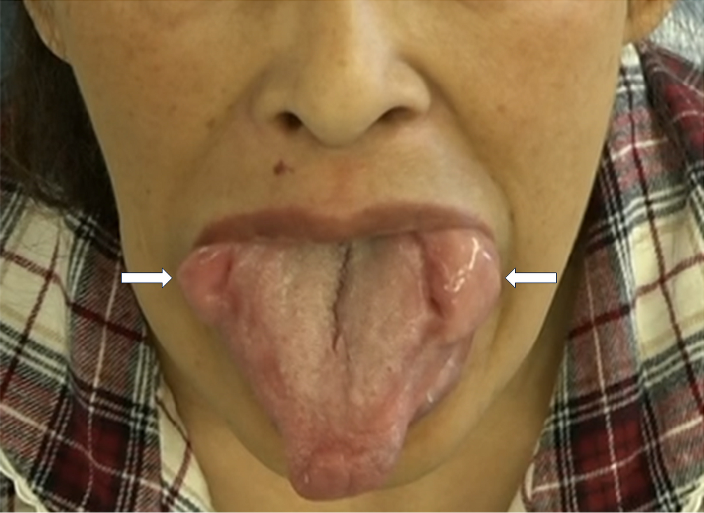 Fragile lip in a patient with macroglossia due to hemodialysis-associated amyloidosis
