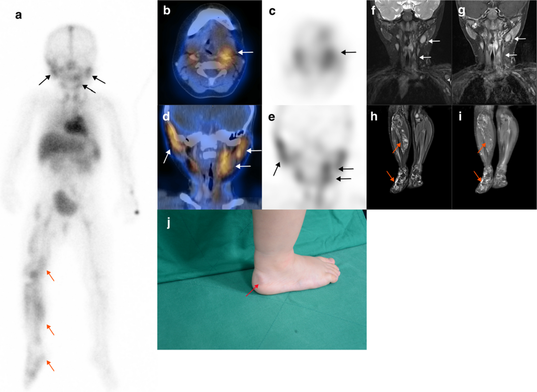Clinical Values of Whole-Body Blood Pool Scans and SPECT for Evaluation of Congenital Vascular Malformation