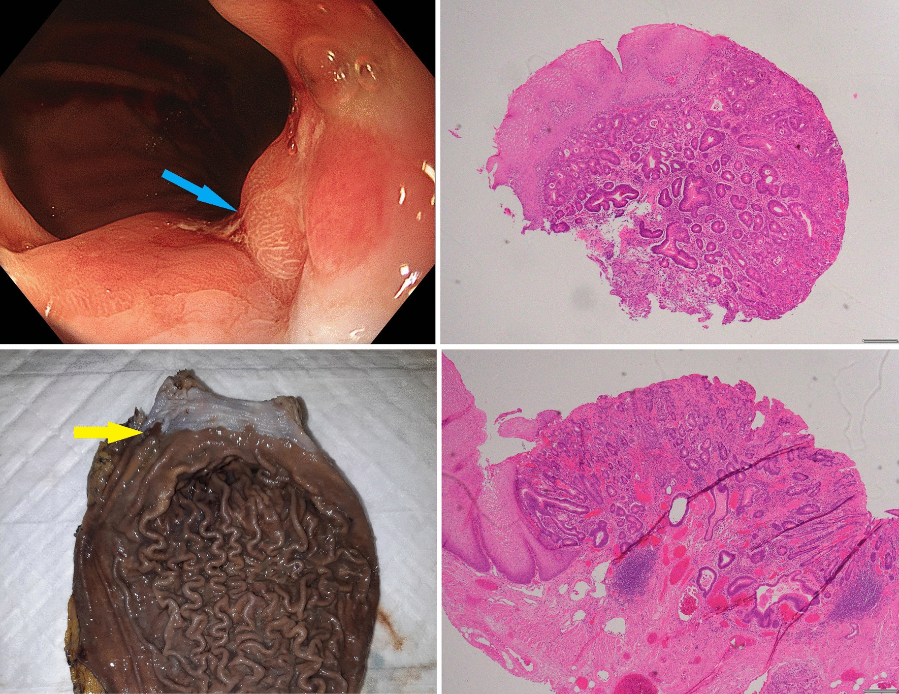 Li Fraumeni Syndrome predisposes to gastro-esophageal junction tumours