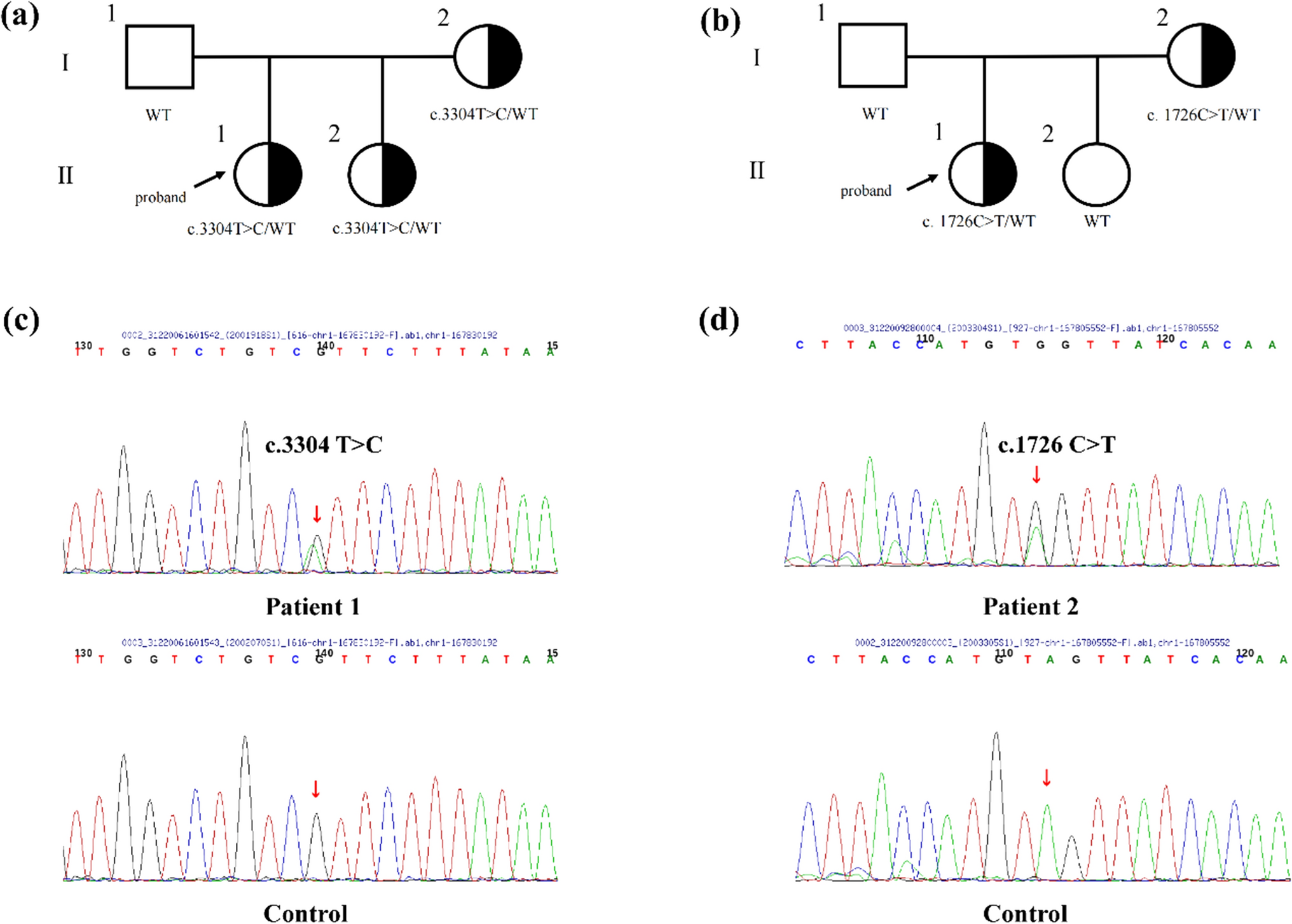 Two novel heterozygous ADCY10 variants identified in Chinese pediatric patients with absorptive hypercalciuria: case report and literature review
