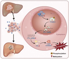 Dual specific phosphatase 4 suppresses ferroptosis and enhances sorafenib resistance in hepatocellular carcinoma