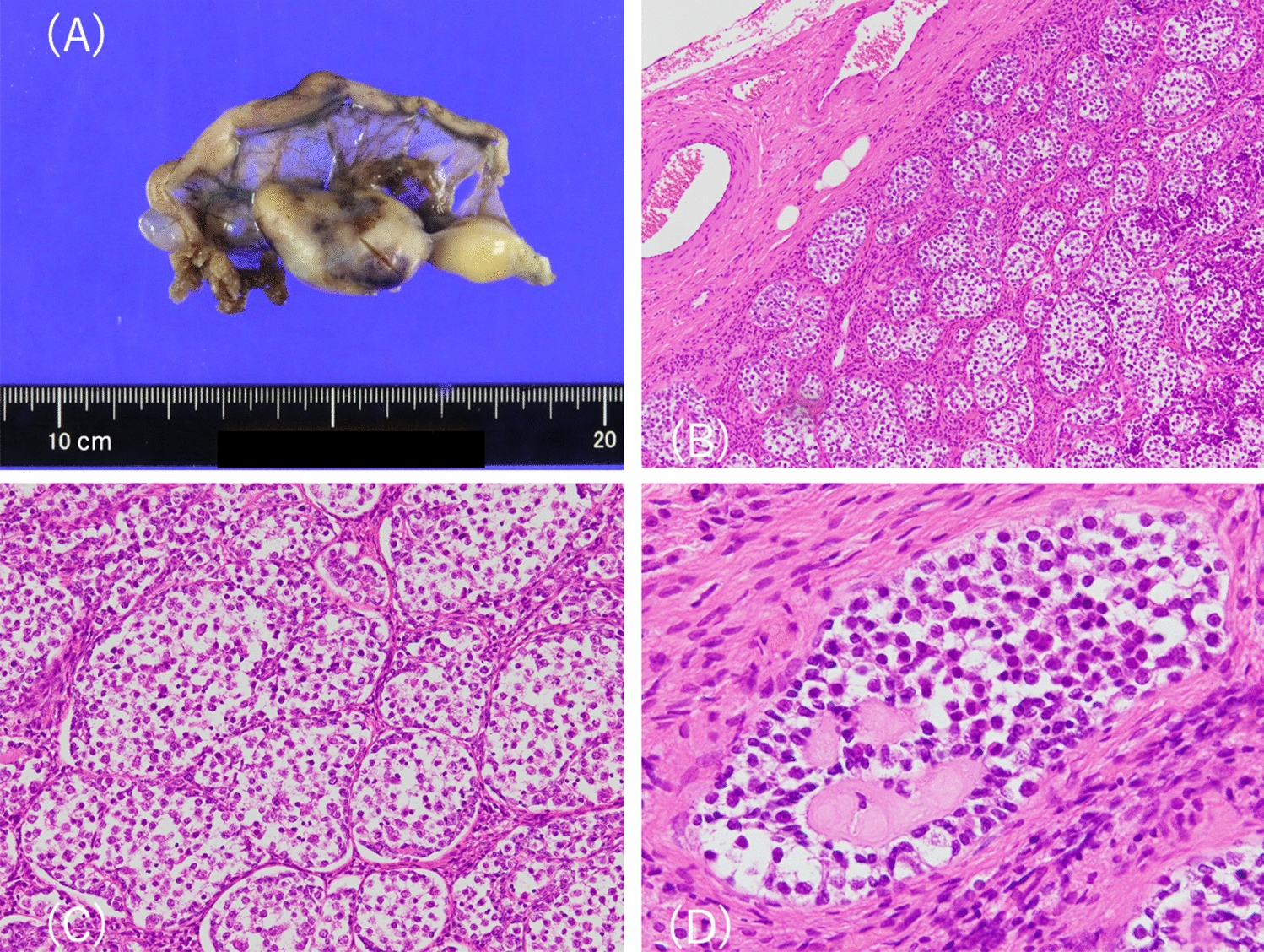 Challenges in the management of Turner syndrome with Y chromosome material: a case report of prophylactic gonadectomy revealing dysgerminoma