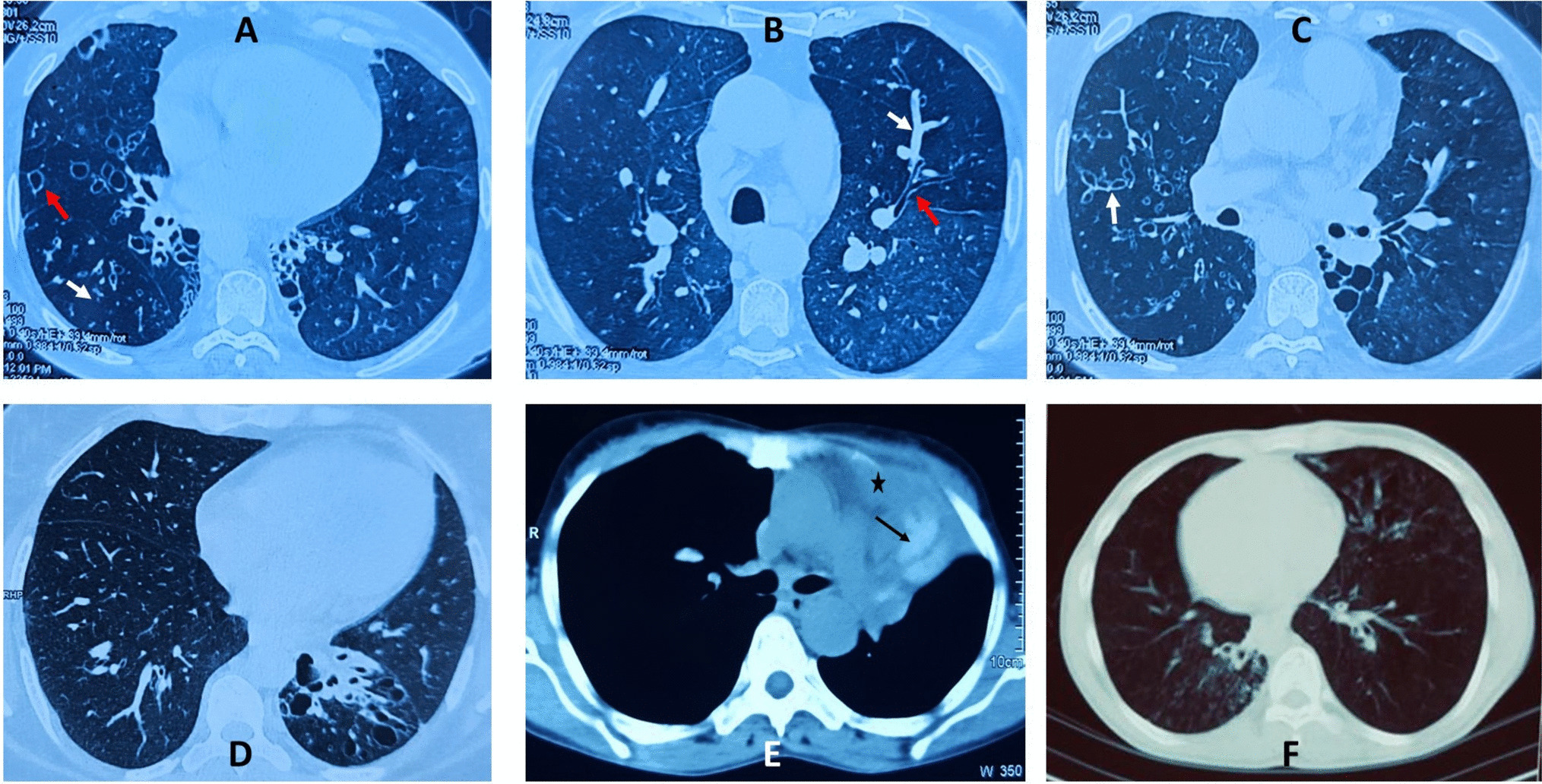 Bronchiectasis: An Evidence-Based Approach to Diagnosis