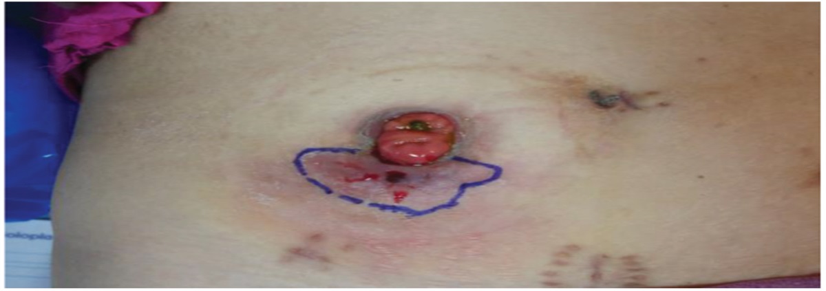 Management of a Peristomal Abscess in a Patient With an Ileostomy: A Case Study