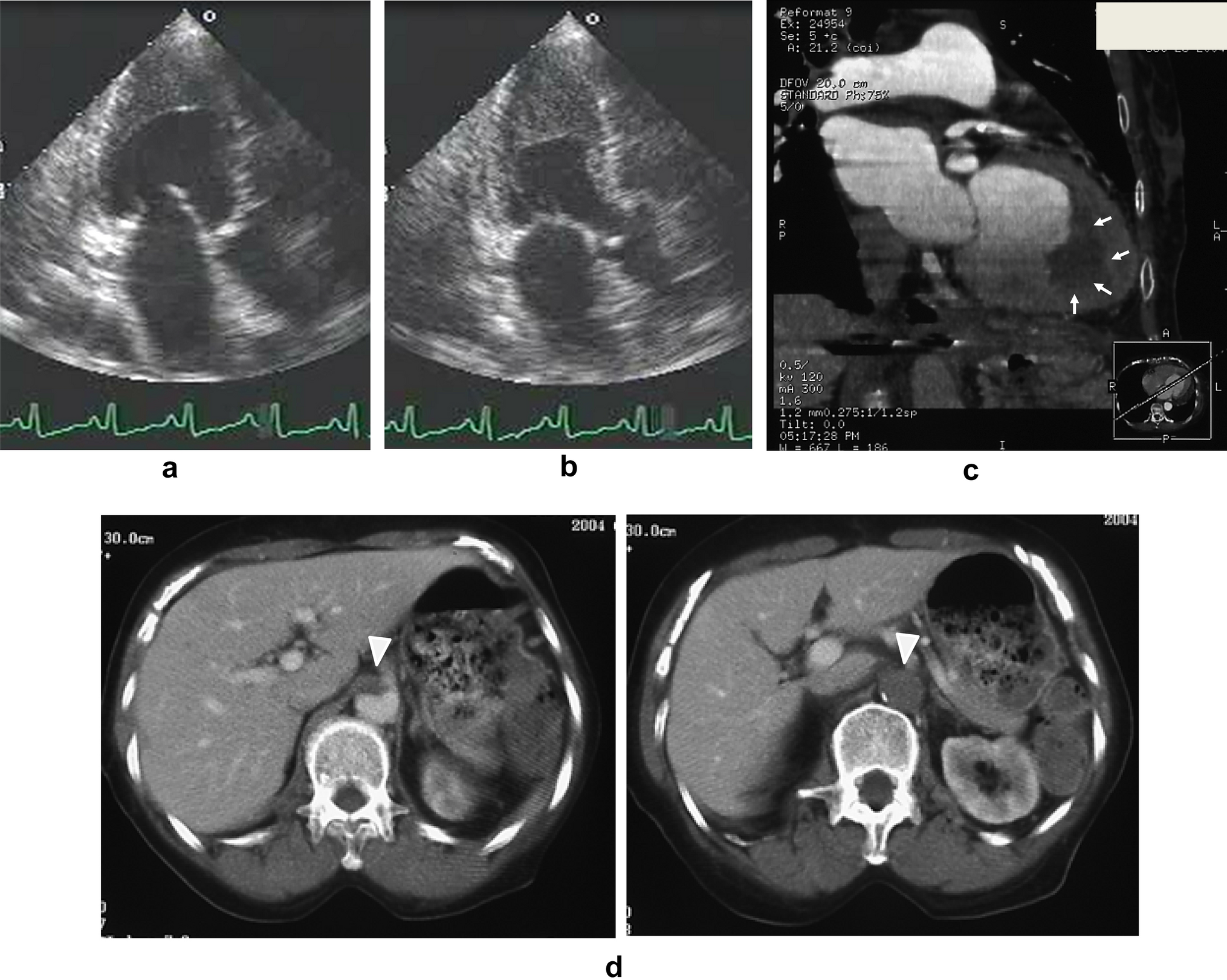 Synchronized motion of intracardiac thrombus with preserved left ventricular contraction in a patient with eosinophilic granulomatosis with polyangiitis