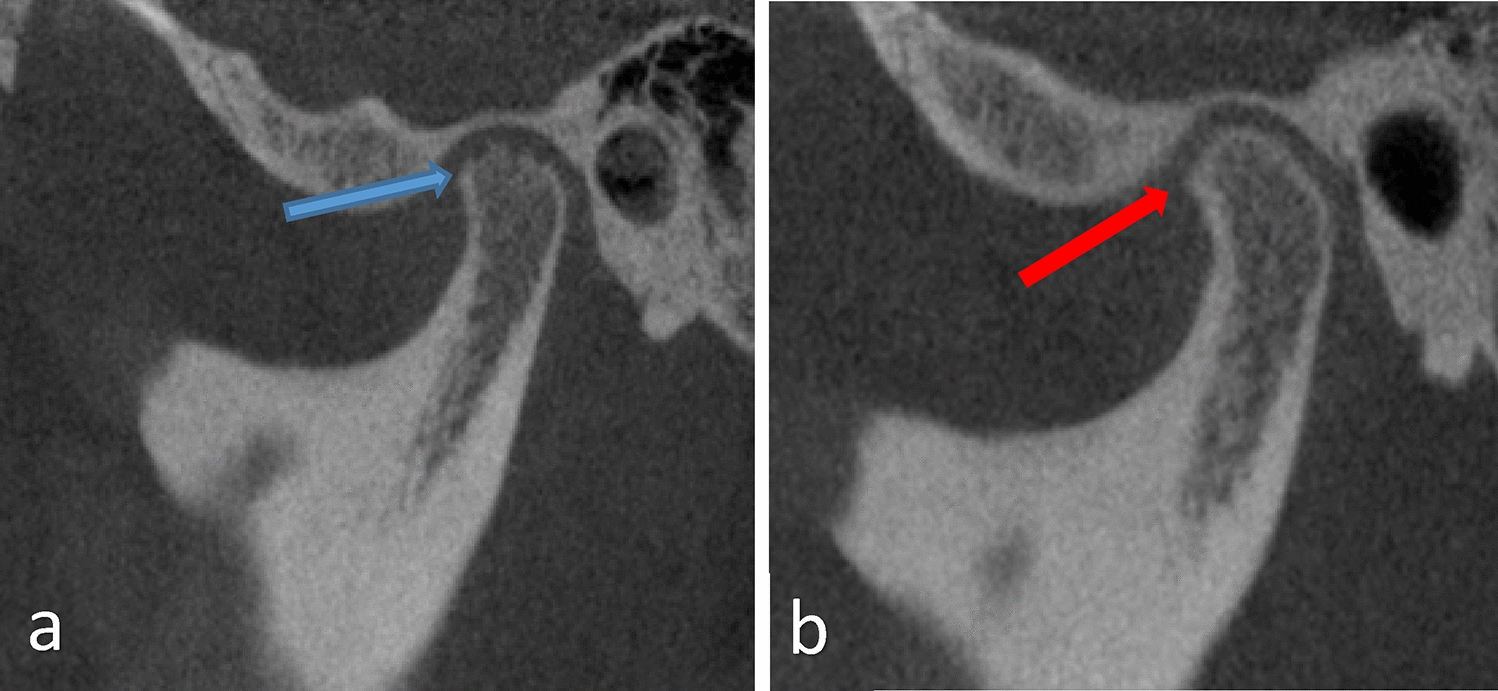 Diagnostic accuracy of MRI–CBCT fused images in assessment of clinically diagnosed internal derangement of the temporomandibular joint