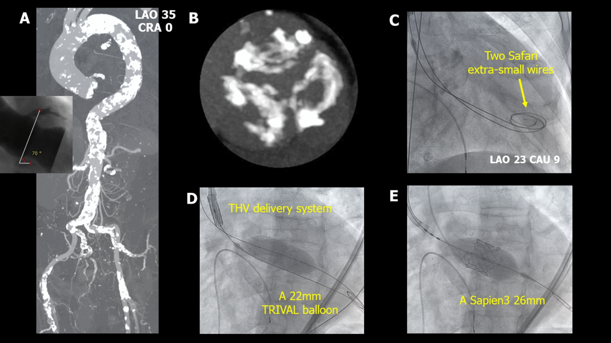 How to evacuate when Sapien3 transcatheter heart valve cannot pass through a severely calcified aortic valve