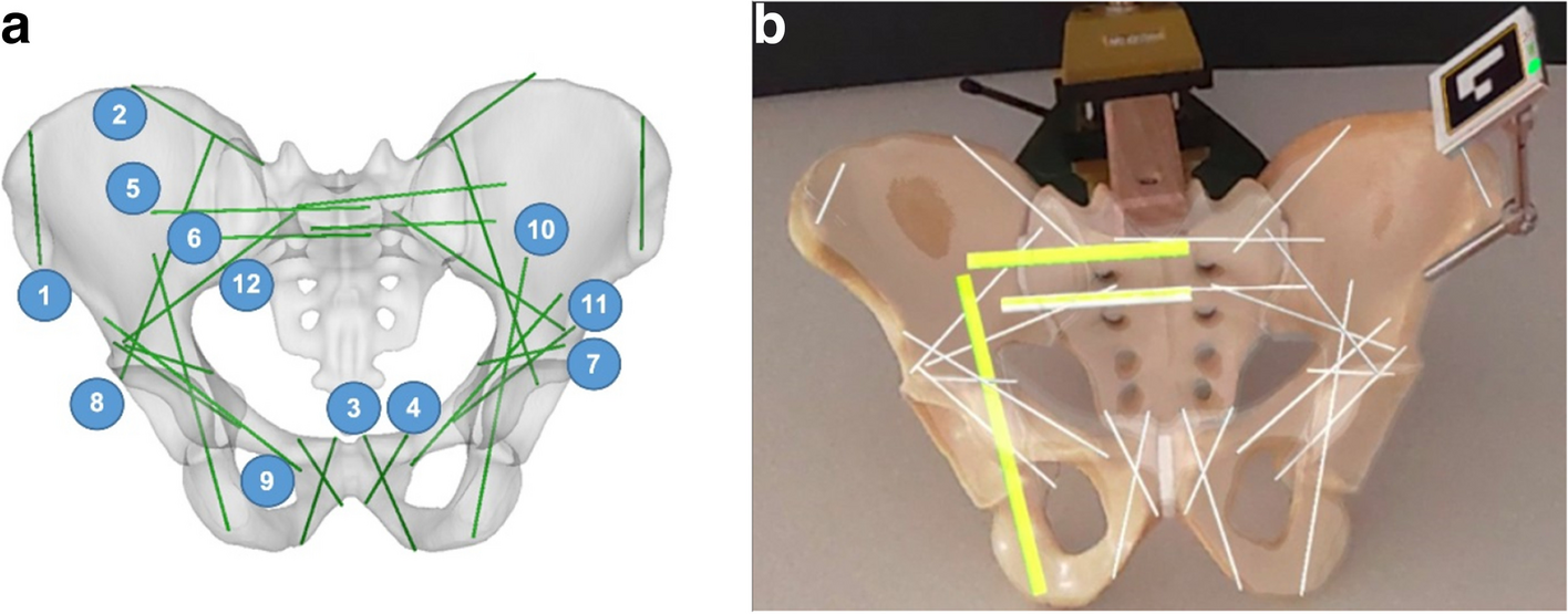 Augmented reality-based surgical navigation of pelvic screw placement: an ex-vivo experimental feasibility study
