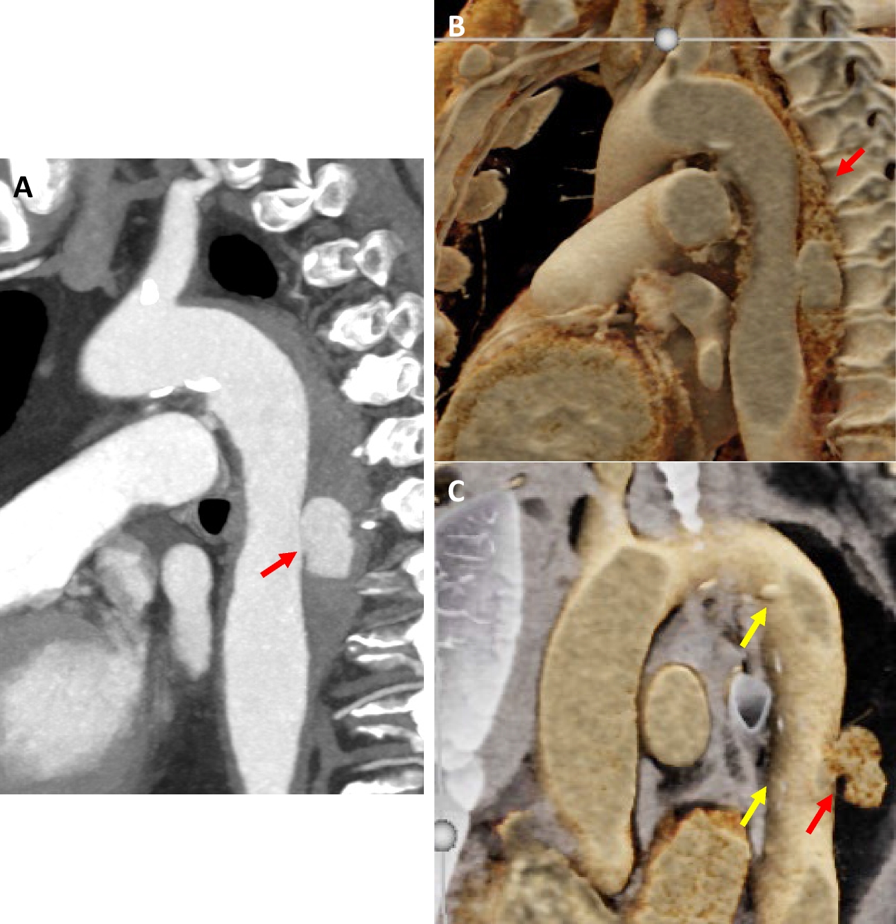 Cinematic rendering of non-traumatic thoracic aorta emergencies: a new look at an old problem