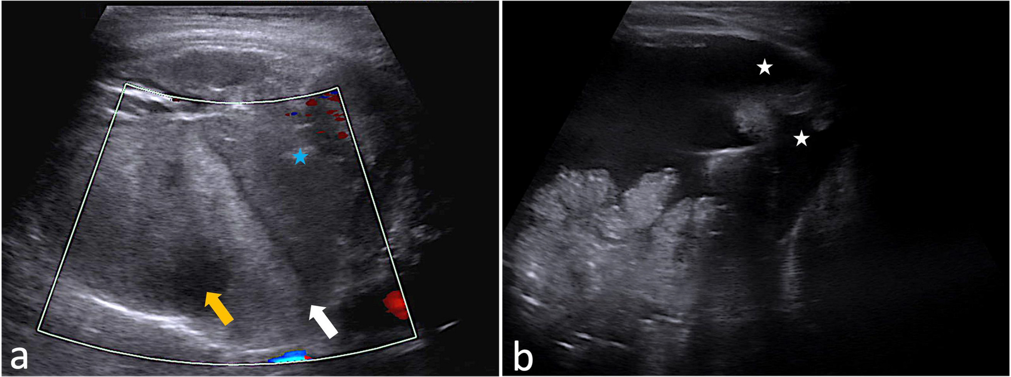 Spontaneous splenic rupture in a neonate: a case report and literature review