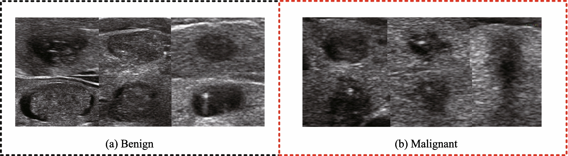 Identification method of thyroid nodule ultrasonography based on self-supervised learning dual-branch attention learning framework