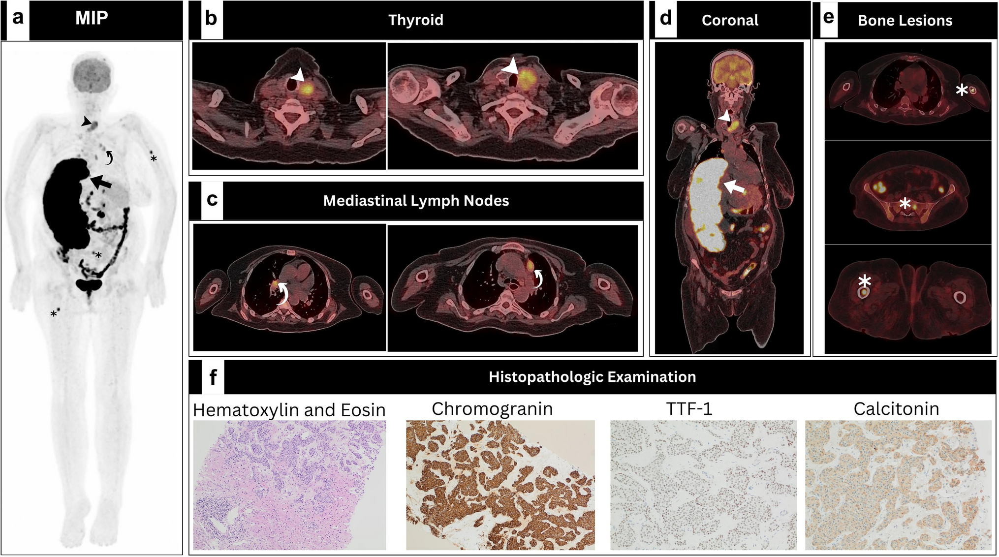 Hepatic Superscan in Medullary Thyroid Carcinoma: A Rare Presentation in [18F]FDG PET/CT
