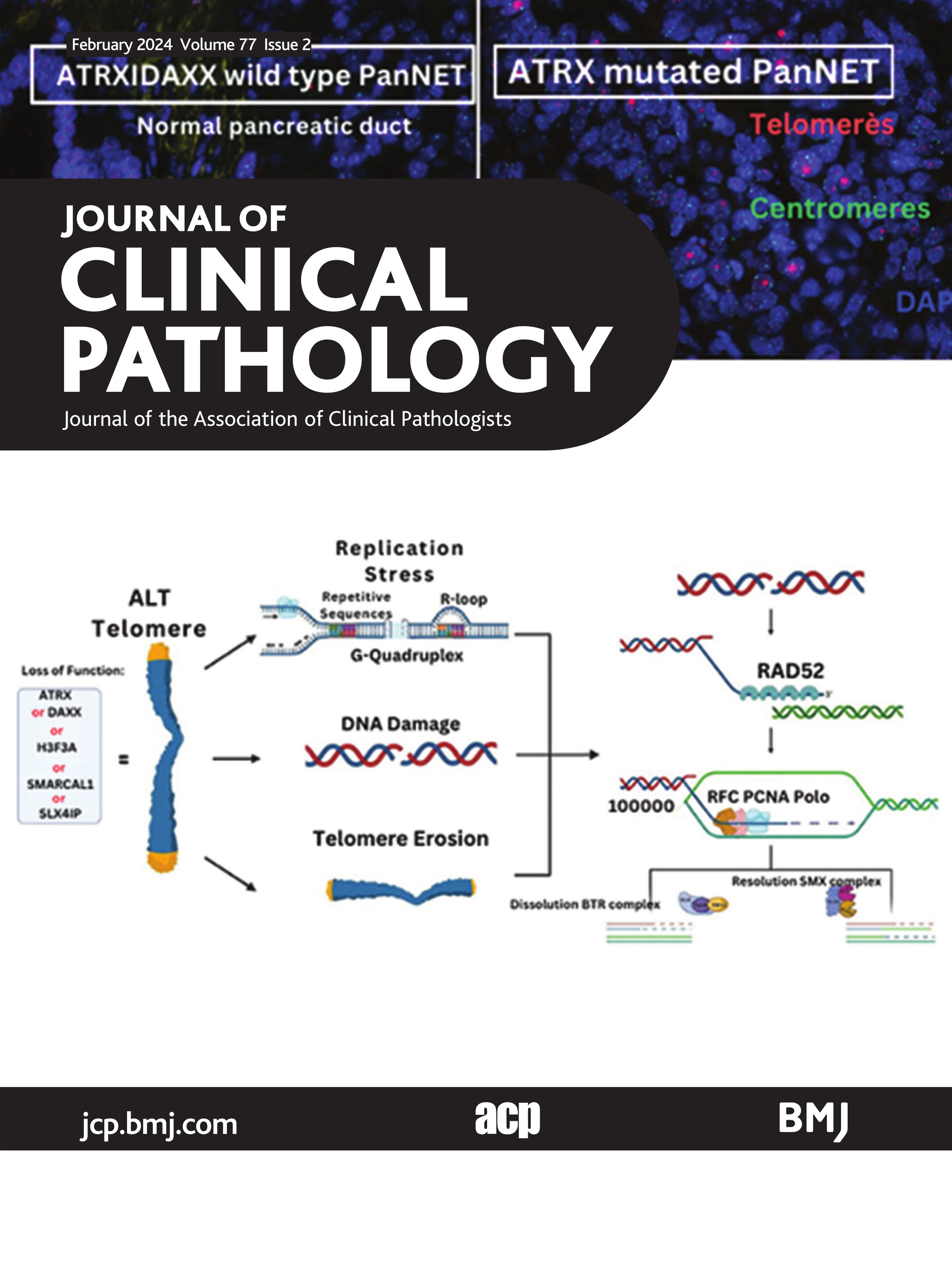 Alternative lengthening of telomeres: mechanism and the pathogenesis of cancer