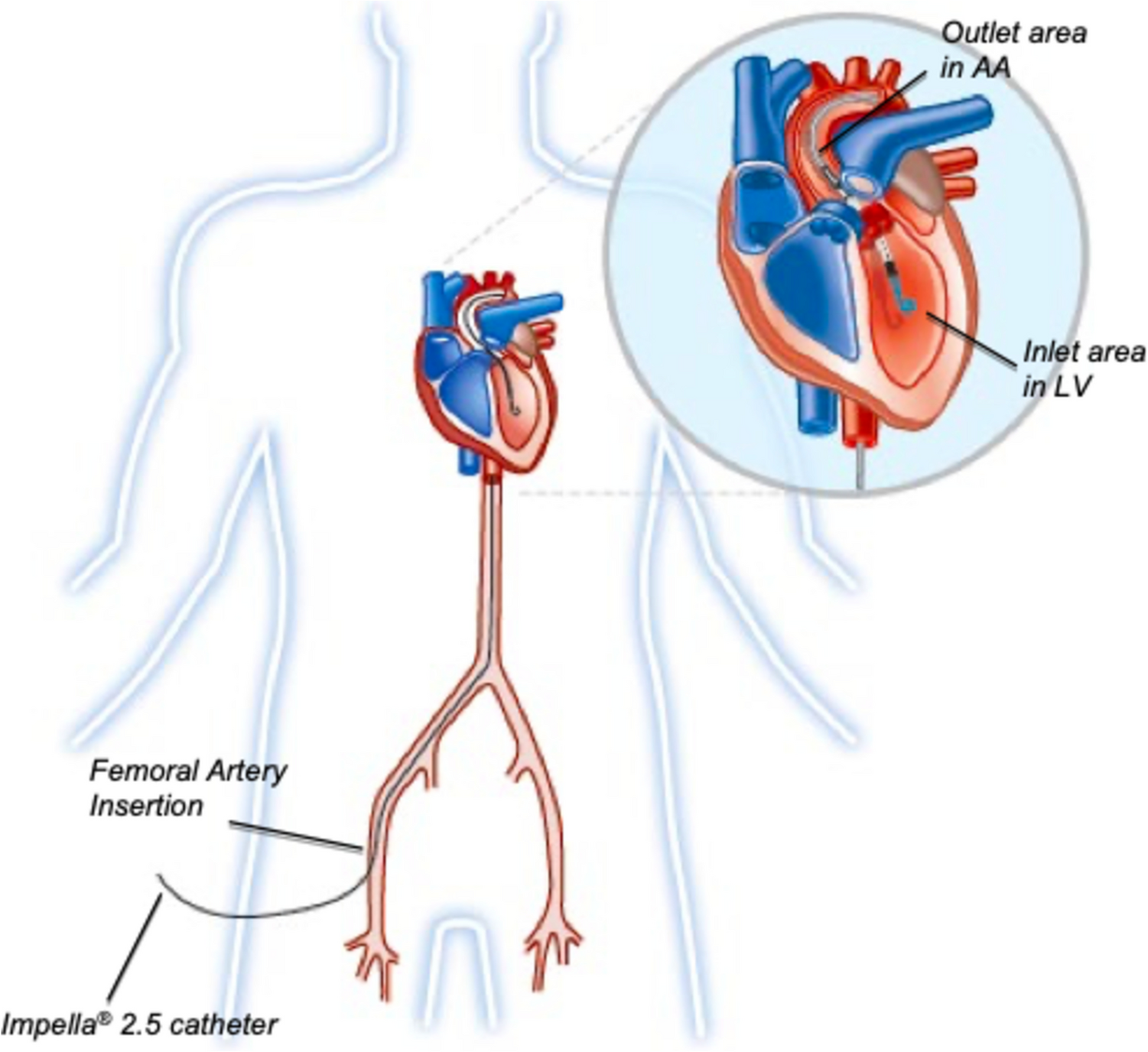 Short-Term Mechanical Circulatory Support Devices: Uses and Outcomes