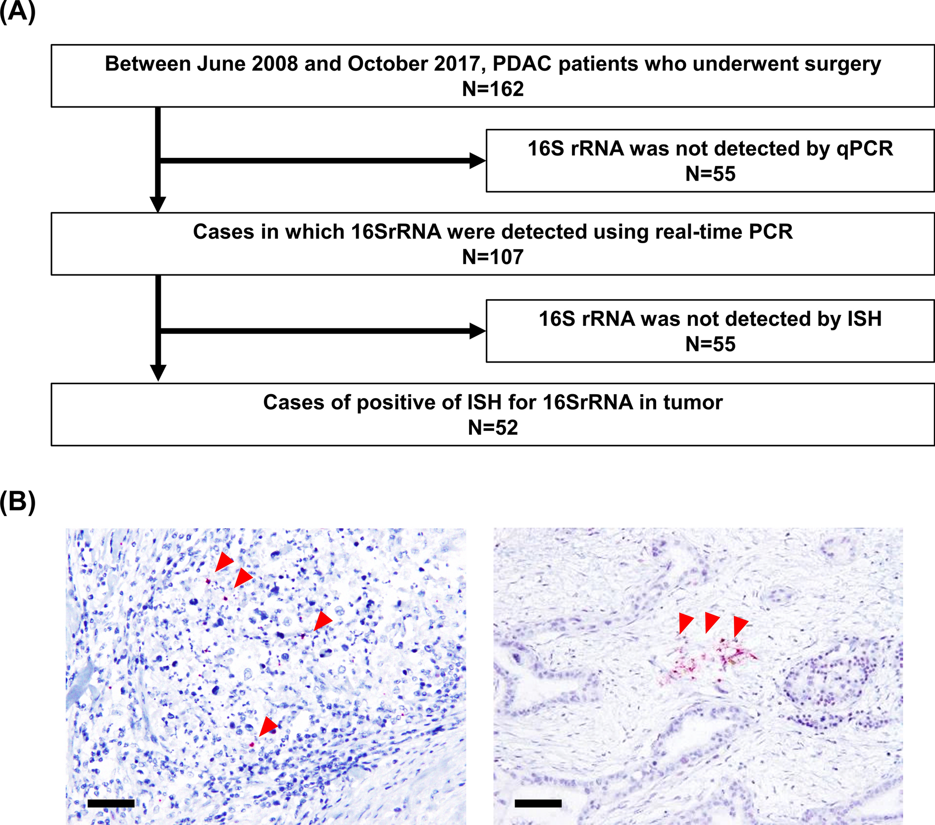 Impact of intratumoral microbiome on tumor immunity and prognosis in human pancreatic ductal adenocarcinoma
