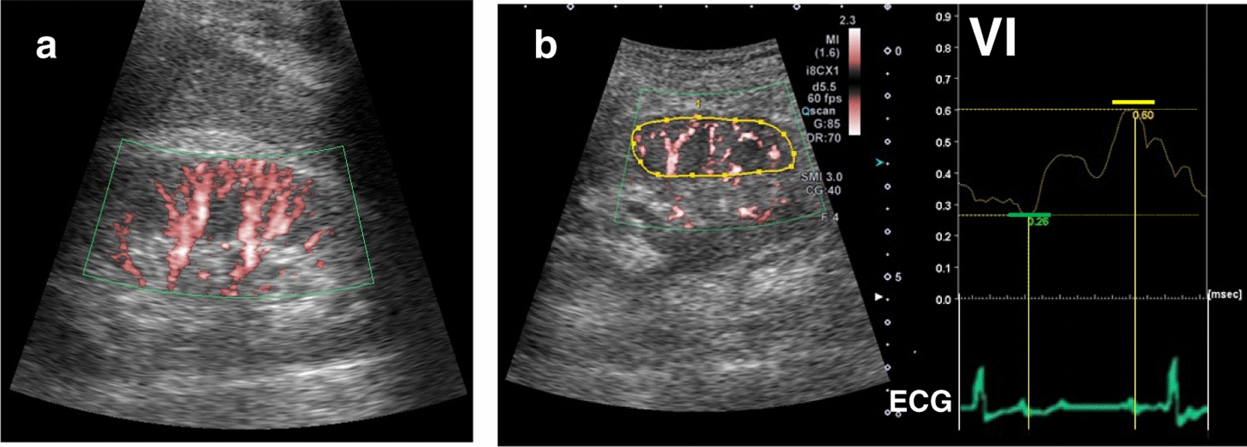 Evaluation of renal circulation in heart failure using superb microvascular imaging, a microvascular flow imaging system