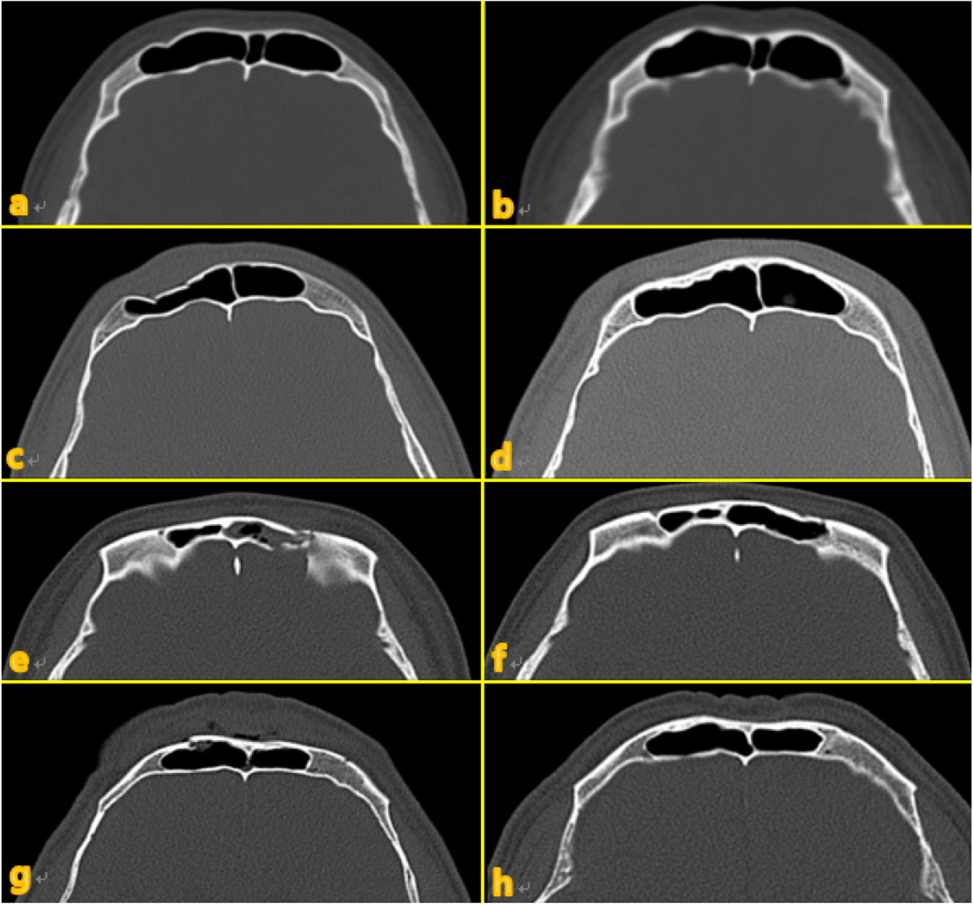 Management of frontal sinus trauma: a retrospective study of surgical interventions and complications