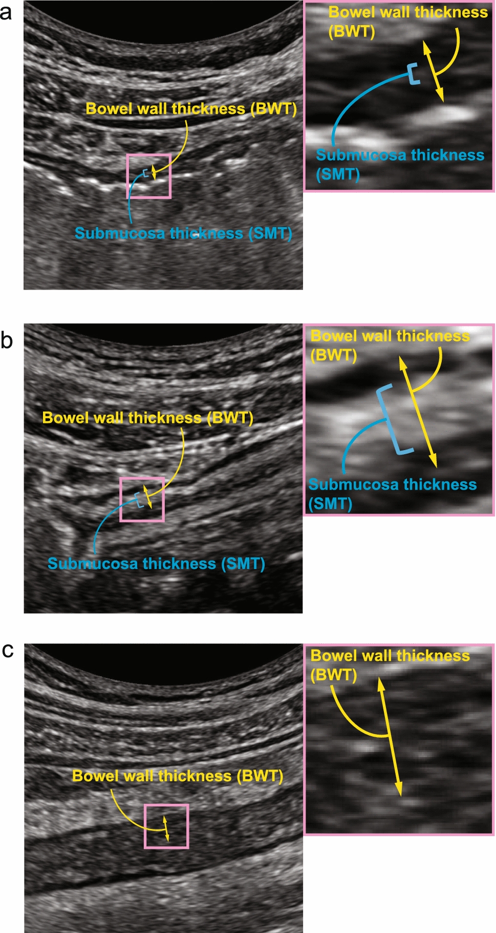 A combination of bowel wall thickness and submucosa index is useful for estimating endoscopic improvement in ulcerative colitis: external validation of the Kyorin Ultrasound Criterion