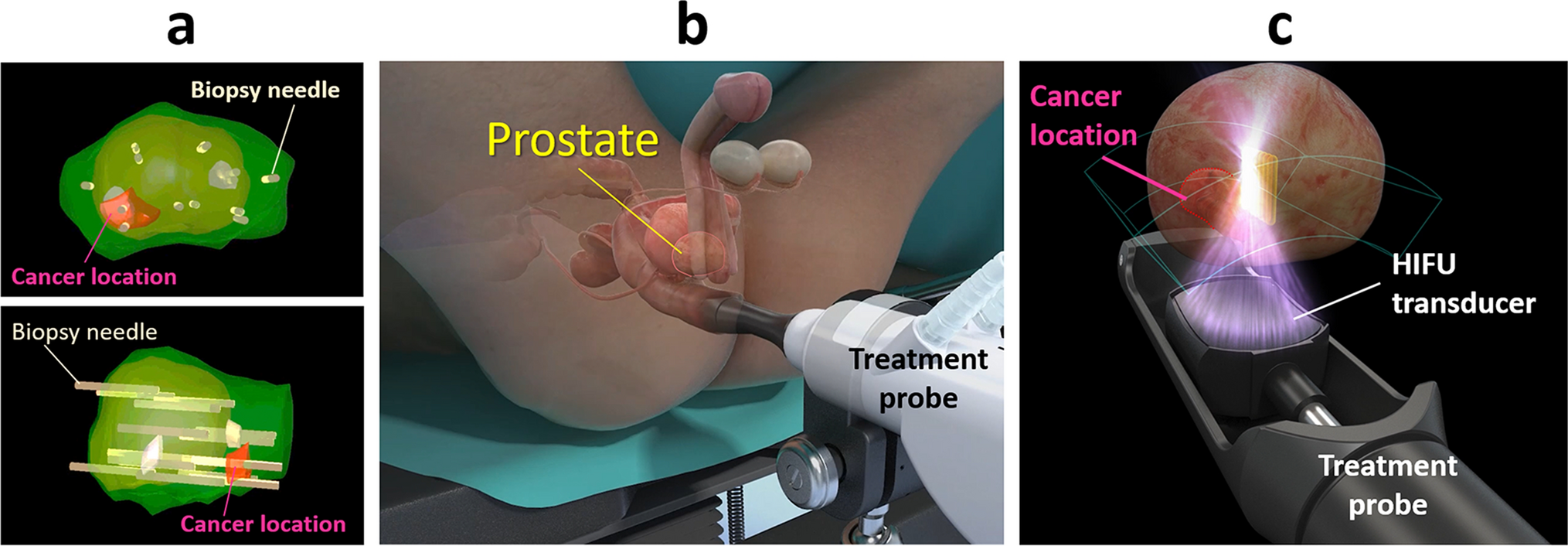 Focal therapy with high-intensity focused ultrasound for localized prostate cancer: approval as advanced medical care and future outlook