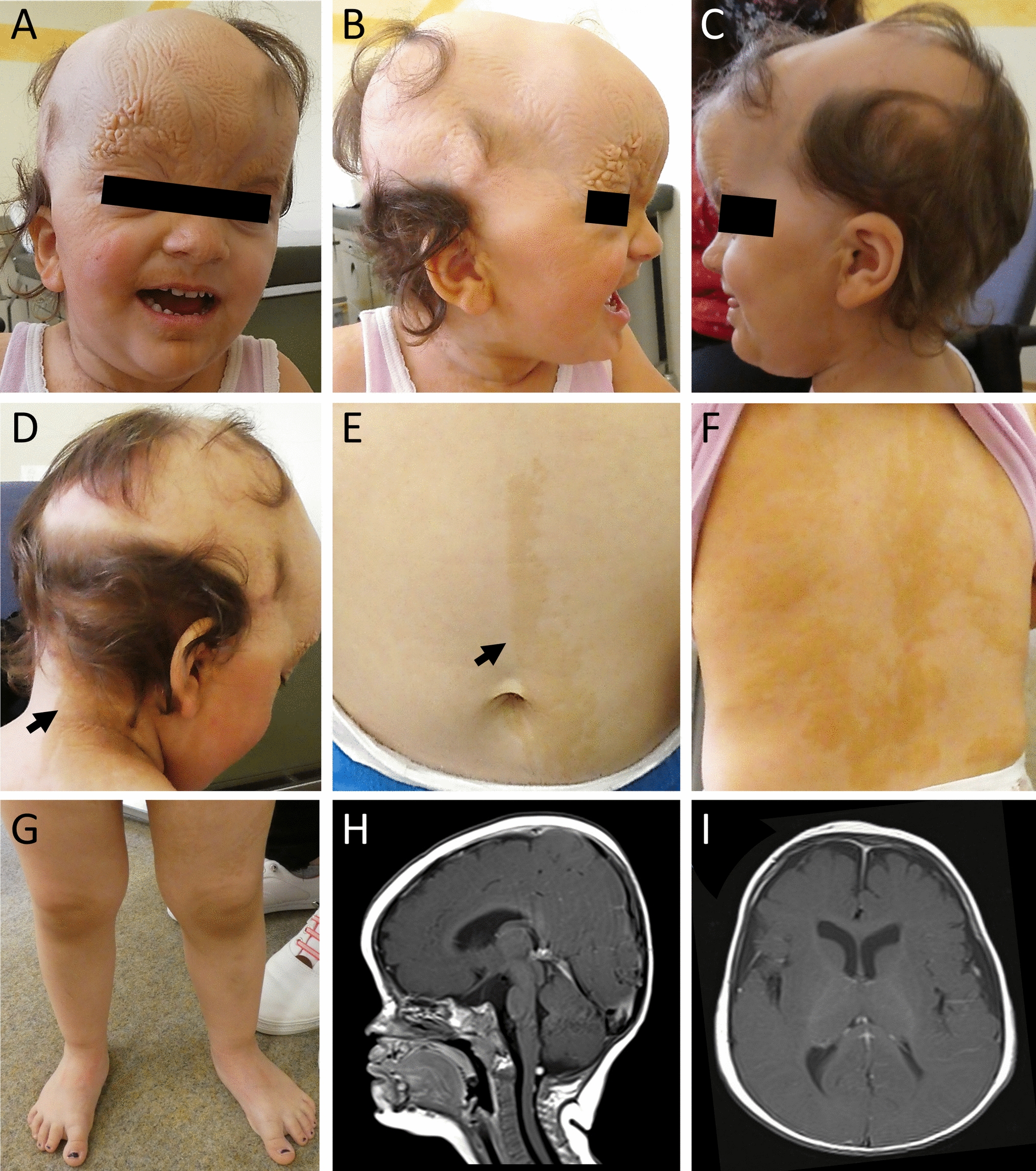 Expansion of the complex genotypic and phenotypic spectrum of FGFR2-associated neurocutaneous syndromes