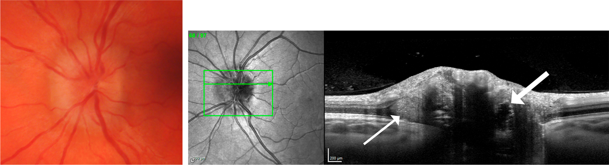 Advantages and Pitfalls of the Use of Optical Coherence Tomography for Papilledema
