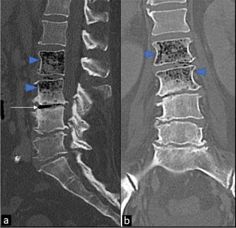 Multifocal emphysematous osteomyelitis, a do not miss diagnosis for the emergency radiologist: a case report with literature review