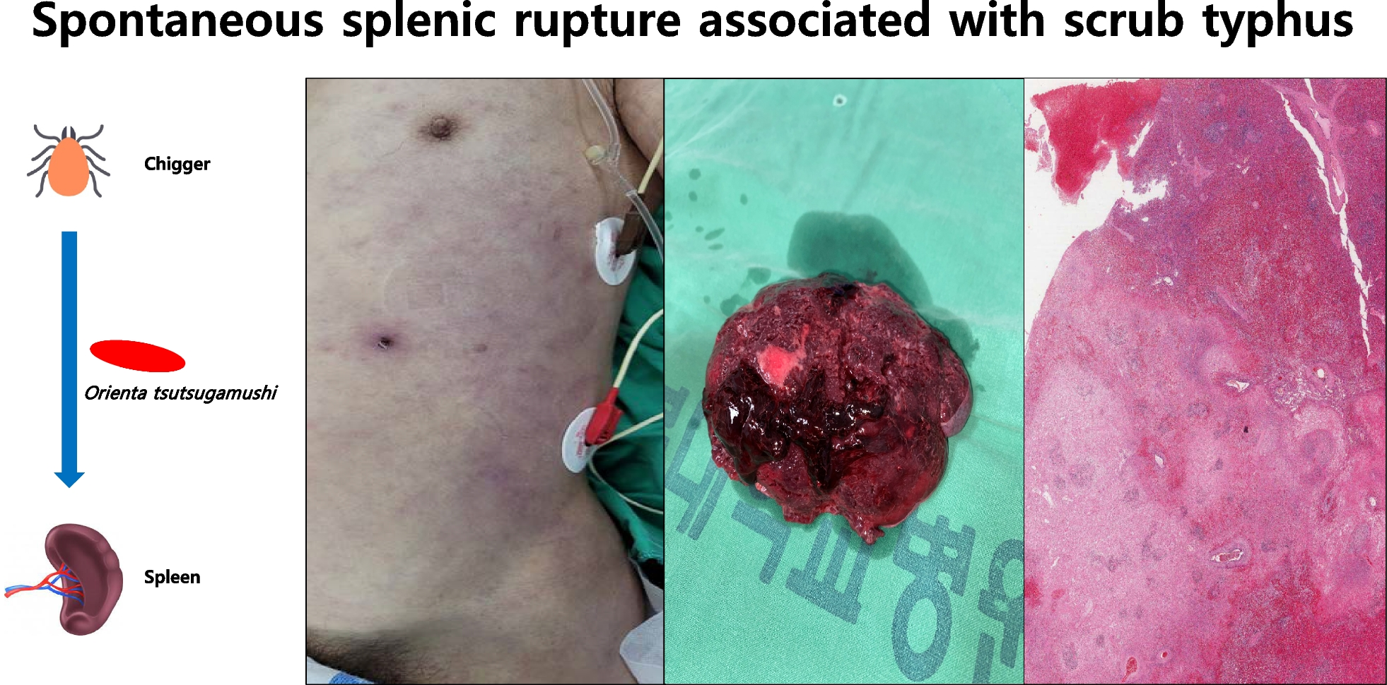 Spontaneous splenic rupture associated with scrub typhus: a case report
