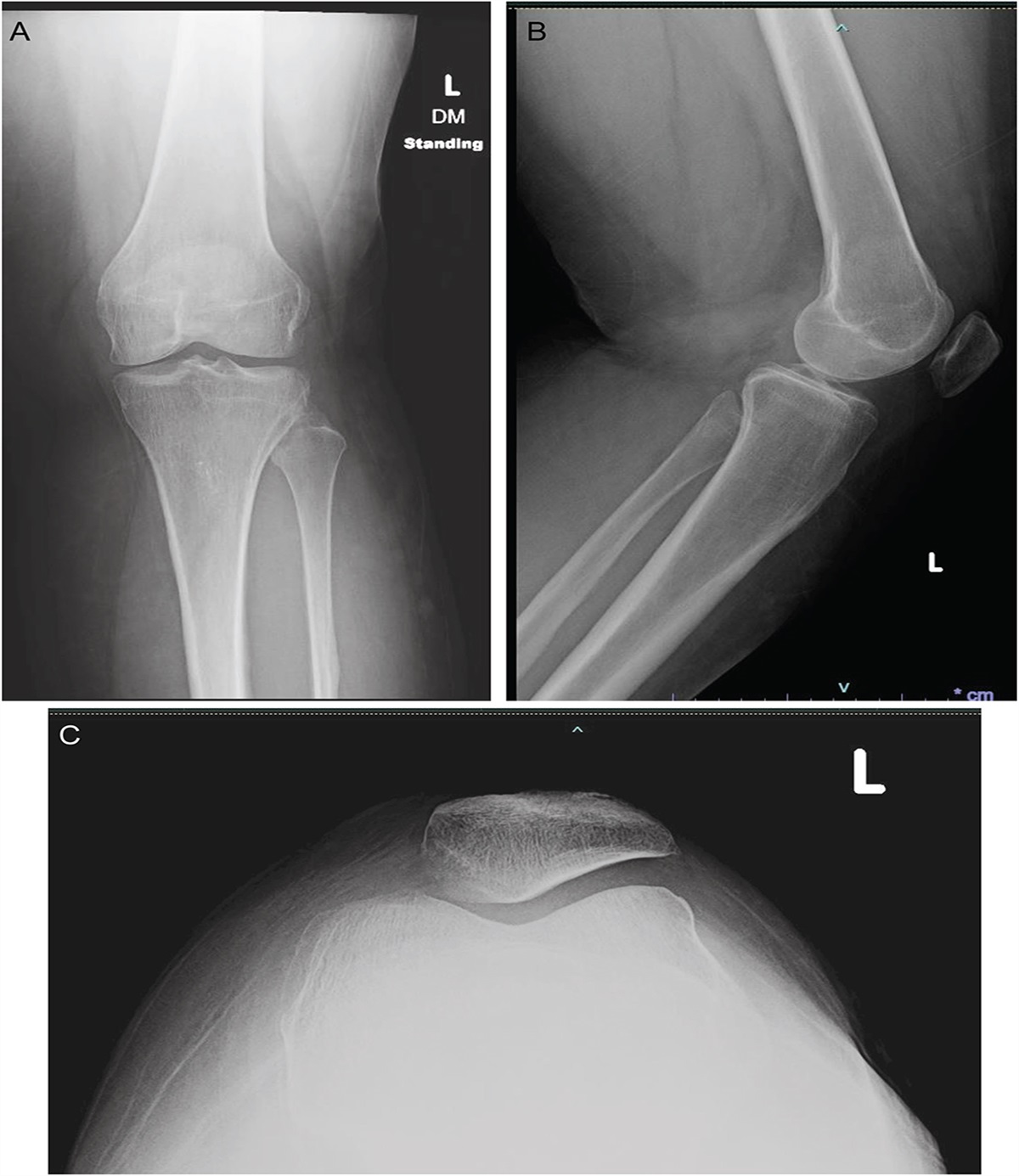Femoral Insufficiency Fracture