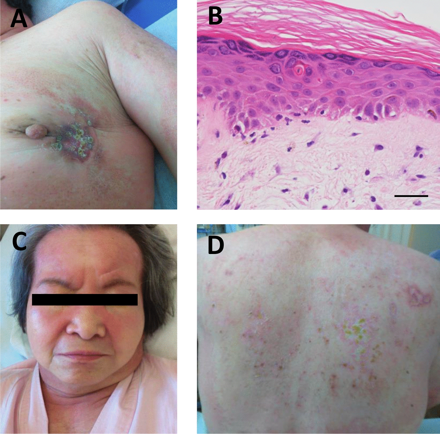 Remarkable remission of symptomatic dermatomyositis after curative breast cancer surgery