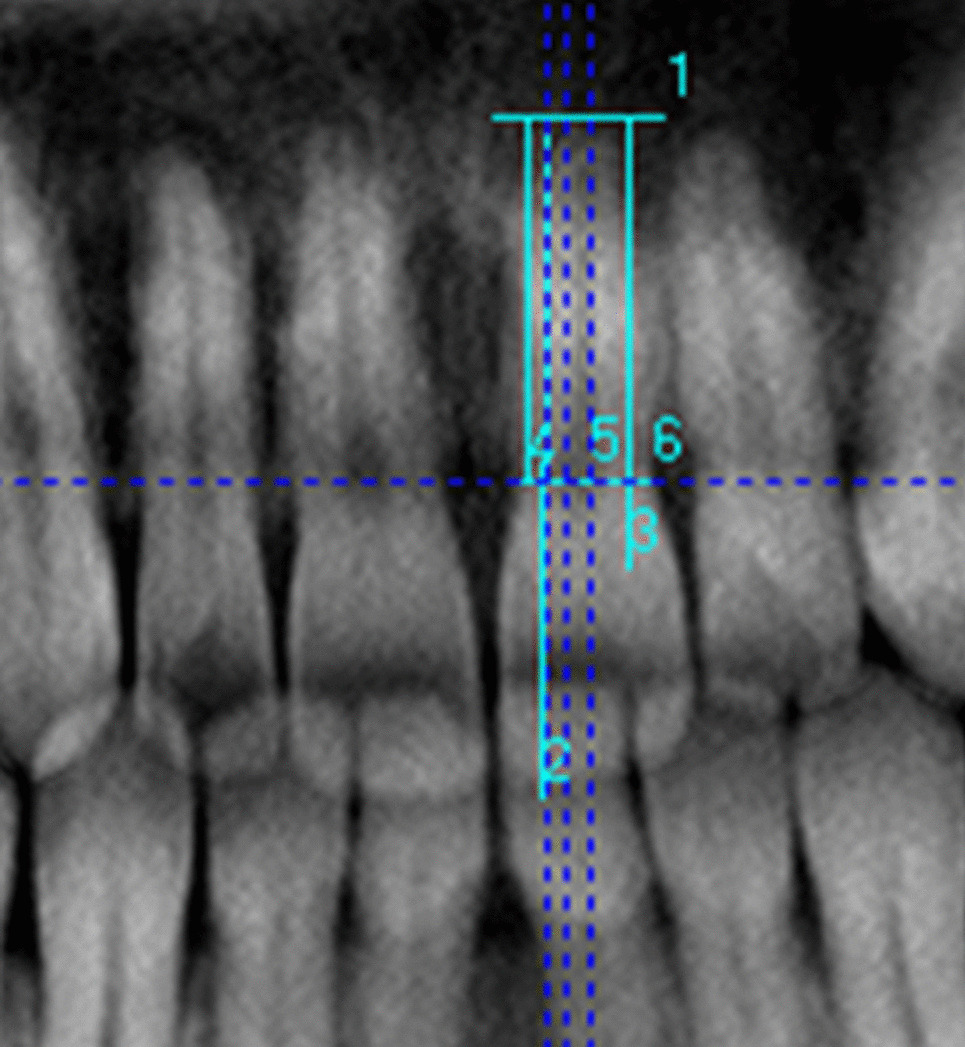 Application of the Kvaal method to CBCT reconstructed panoramic images for age estimation