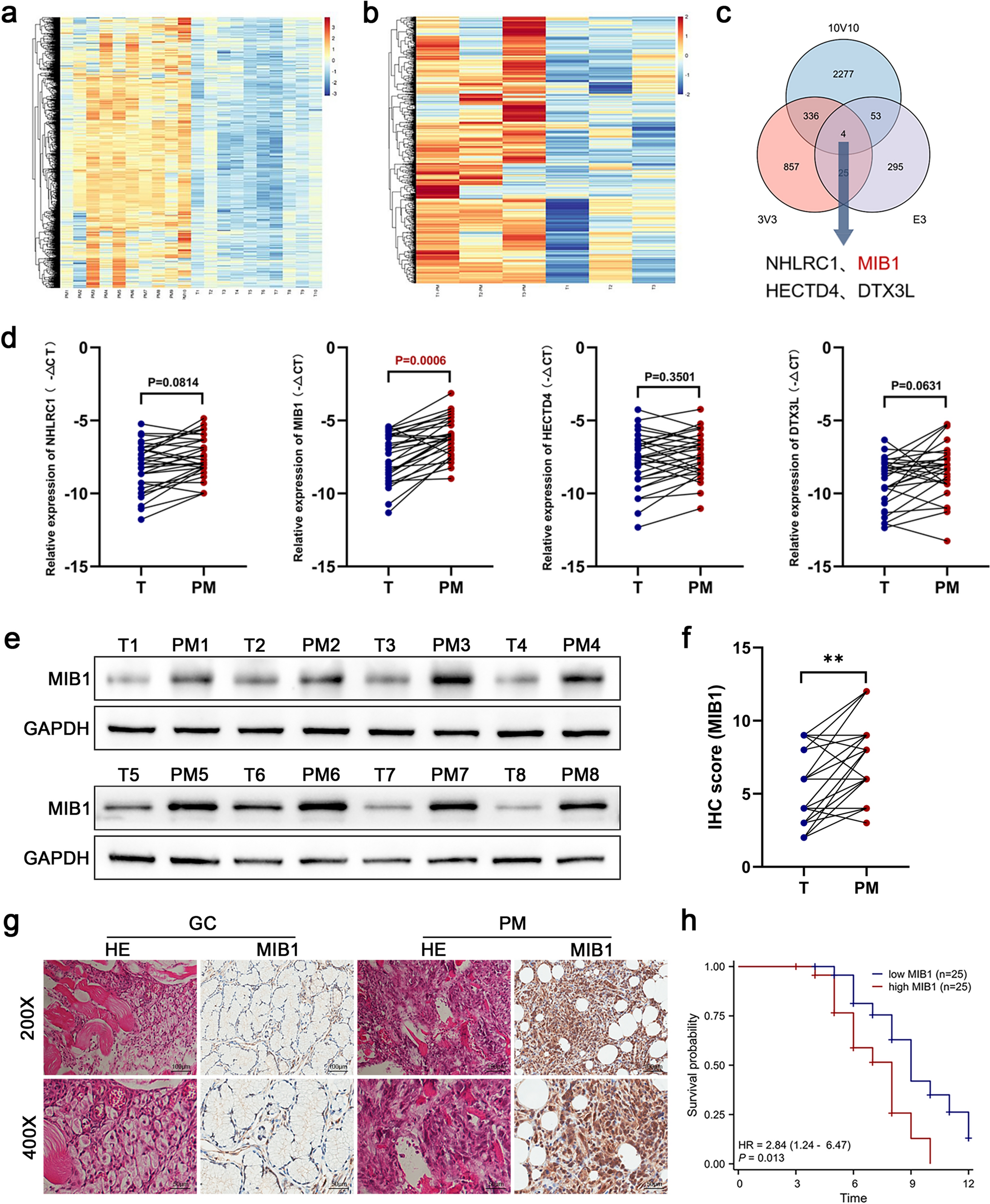 N6-methyladenosine-modified MIB1 promotes stemness properties and peritoneal metastasis of gastric cancer cells by ubiquitinating DDX3X