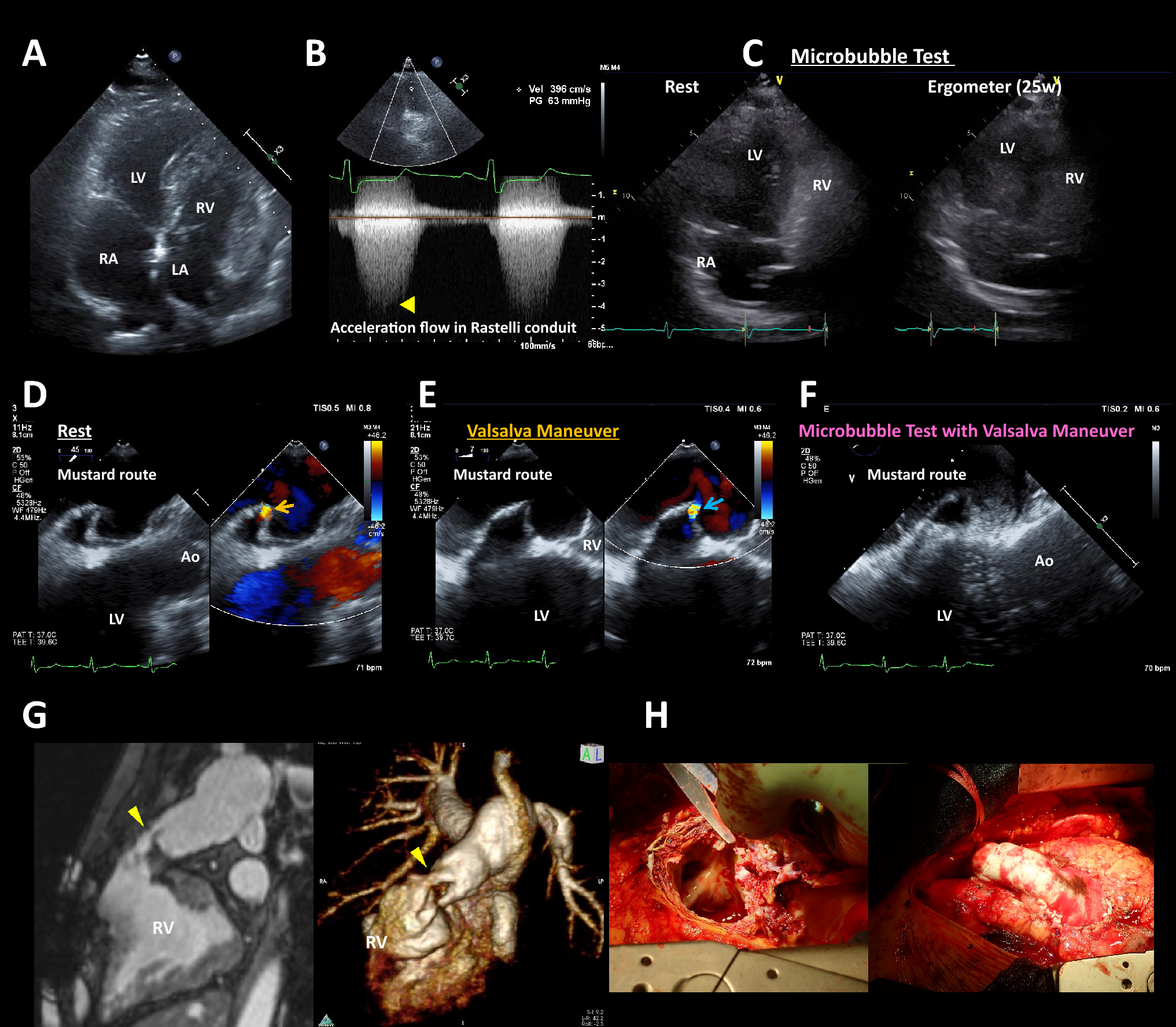 Contrast echocardiography during exercise stress in a case of congenitally corrected transposition of the great arteries after double-switch operation