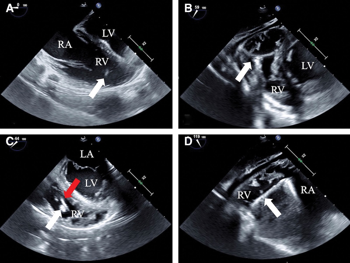 Wireless Interrogation During Cardiac Surgery For a Patient With Aveir Leadless Pacemaker: A Case Report